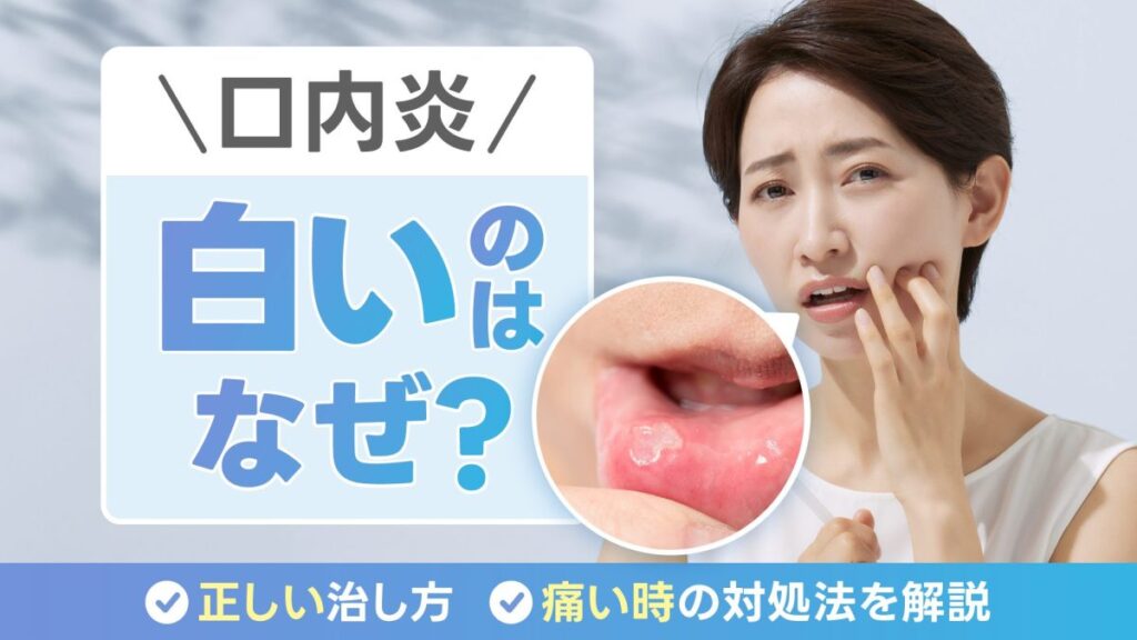 口内炎が白いのはなぜ？正しい治し方や痛い時の対処法を解説