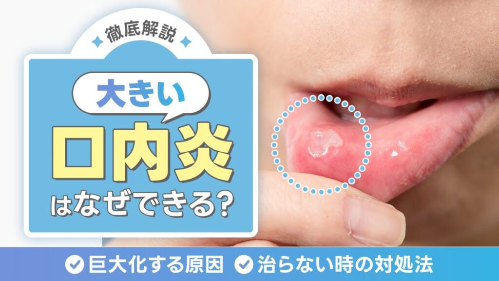 大きい口内炎はなぜできる？どんどん巨大化する原因や治らない時の対処法を解説