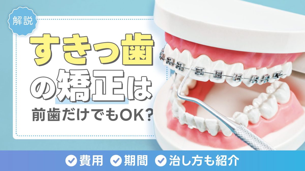 すきっ歯の矯正は前歯だけでもOK？費用・期間・治し方を徹底解説