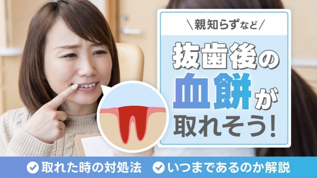 親知らずなど抜歯後の血餅が取れそう！取れた時の対処法やいつまであるのかを解説