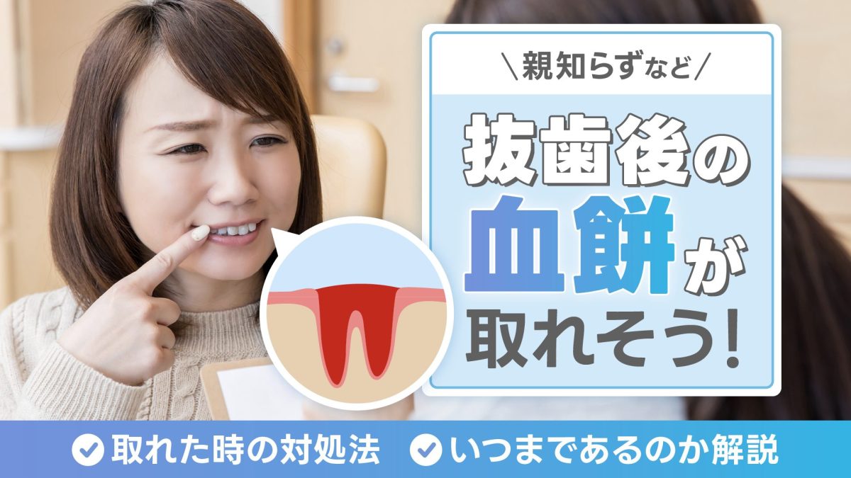 親知らずなど抜歯後の血餅が取れそう！取れた時の対処法やいつまであるのかを解説