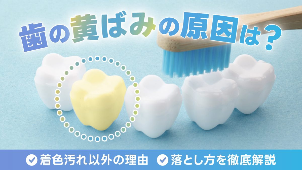 歯の黄ばみの原因は？ひどいときの着色汚れ以外の理由や落とし方を徹底解説